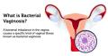 واژینوز باکتریال(Bacterial vaginosis)