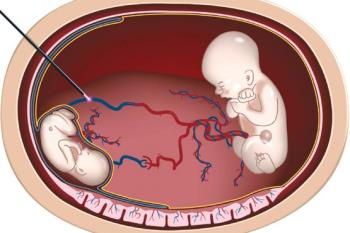 نکاتی کاربردی در مورد غربالگری در بارداریهای دوقلویی