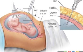 مروری بر تست تشخیصی آمنیوسنتز در دوران بارداری