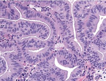 نحوه پیگیری سلولهای خوش خیم اندومتر Benign Endometrial Cells (BEC) و یا سلولهای خوش خیم گلاندولار Benign Glandular Cells طبق آخرین گایدلاین ASCCP 2019
