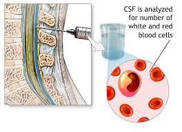 مروری بر سلول های مایع مغزی _ نخاعی (CSF)
