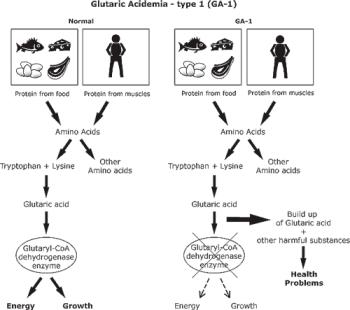 اختلالات متابولیک اسید های اُرگانیک: Glutaric acidemia, type 1 deficiency