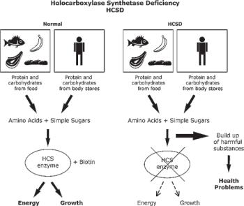 اختلالات متابولیک اسیدهای اُرگانیک-Holocarboxylase synthetase deficiency