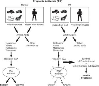 اختلالات متابولیک اسید های اُرگانیک: Propionic Acidemia