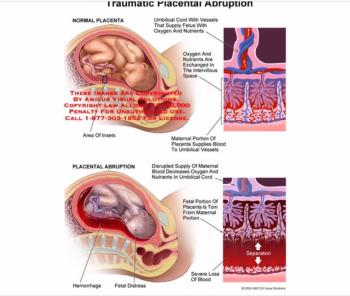 خونریزی جنینی - مادری (FMH) چیست؟