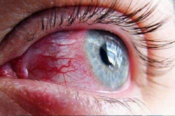 متخصص چشم: التهاب چشم یکی از نشانه های کروناست